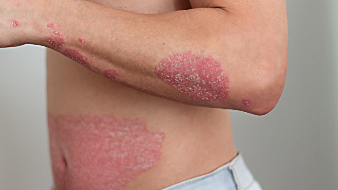 Psoriasis en el brazo y el vientre